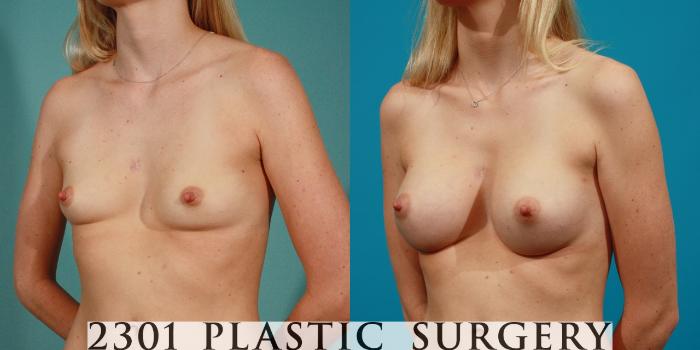 Before & After Breast Augmentation Case 79 View #3 View in Fort Worth, Plano, & Frisco, Texas