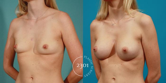 Before & After Breast Augmentation Case 79 View #3 View in Fort Worth, Plano, & Frisco, Texas