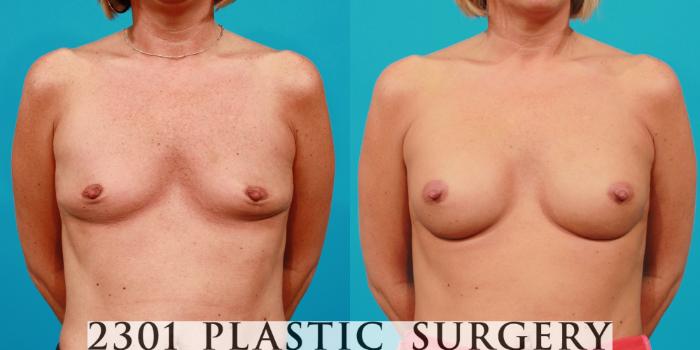 Before & After Silicone Implants Case 88 View #1 View in Fort Worth, Plano, & Frisco, Texas