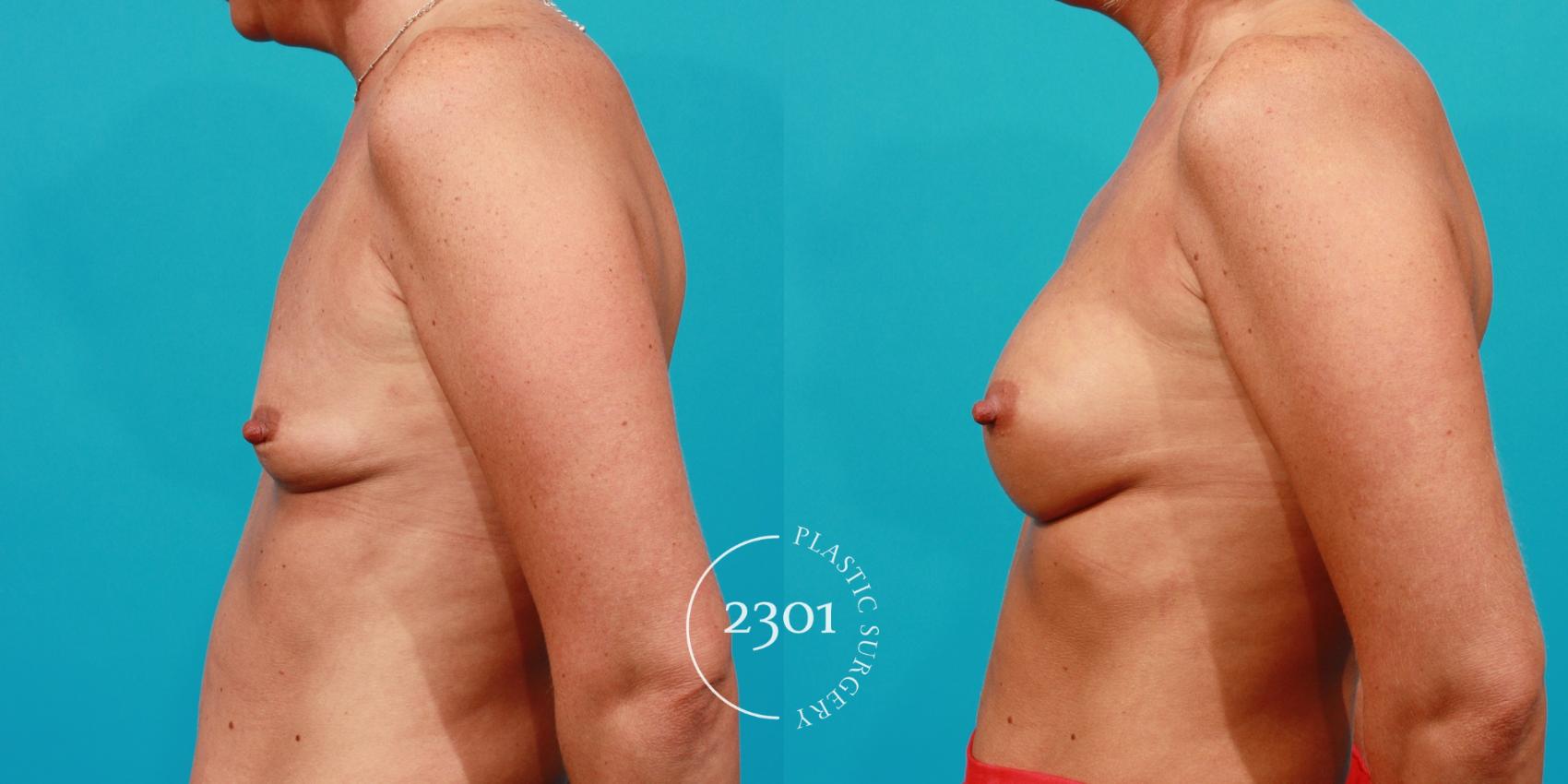 Before & After Silicone Implants Case 88 View #2 View in Fort Worth, Plano, & Frisco, Texas