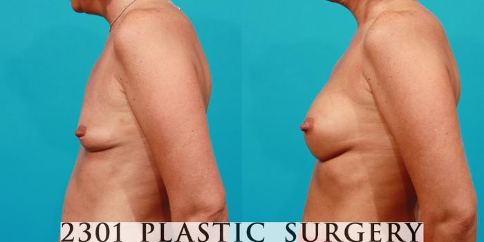 Before & After Silicone Implants Case 88 View #2 View in Fort Worth, Plano, & Frisco, Texas