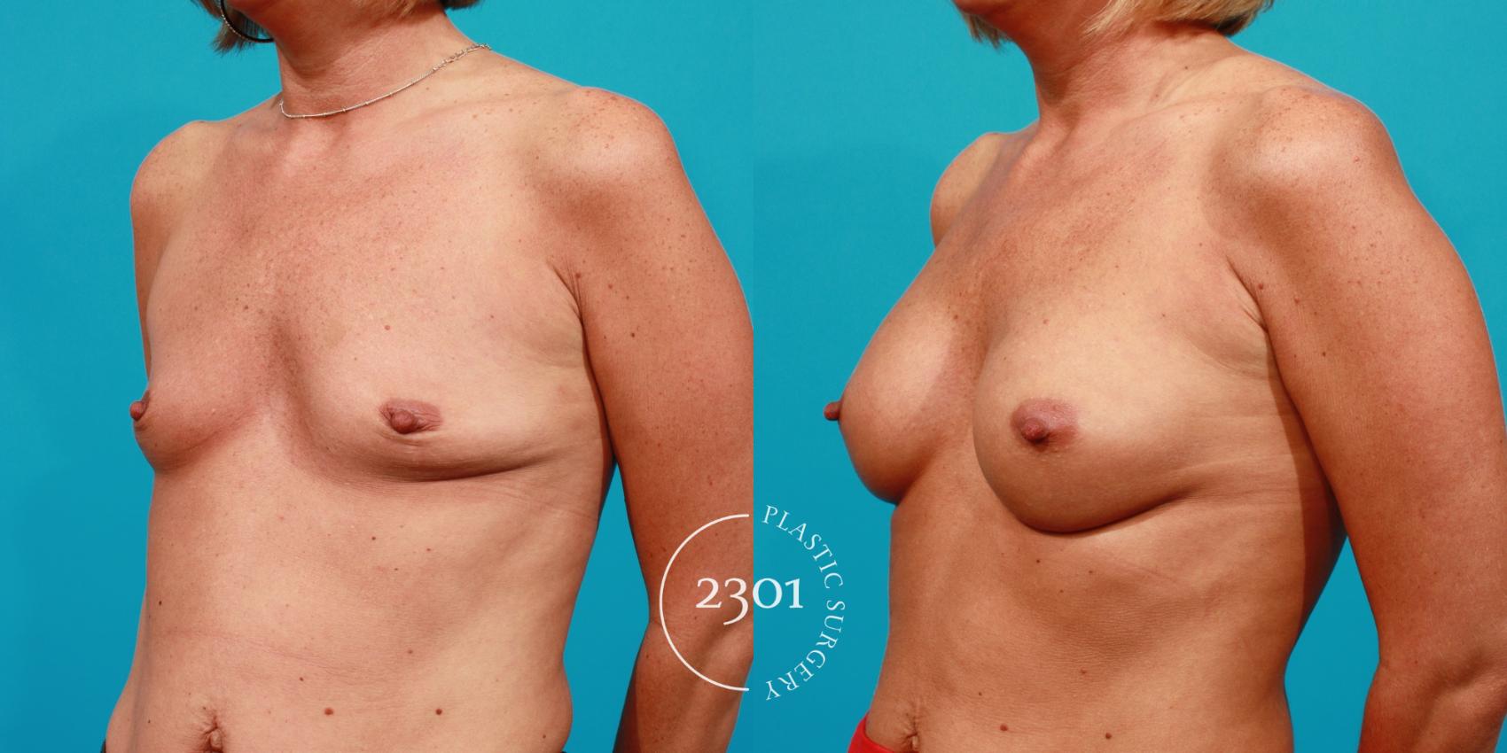Before & After Silicone Implants Case 88 View #3 View in Fort Worth, Plano, & Frisco, Texas