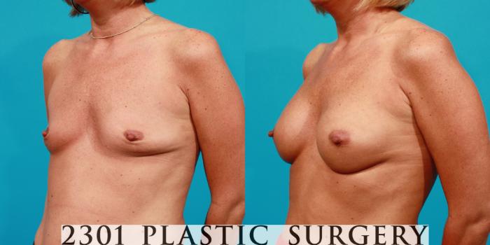 Before & After Silicone Implants Case 88 View #3 View in Fort Worth, Plano, & Frisco, Texas