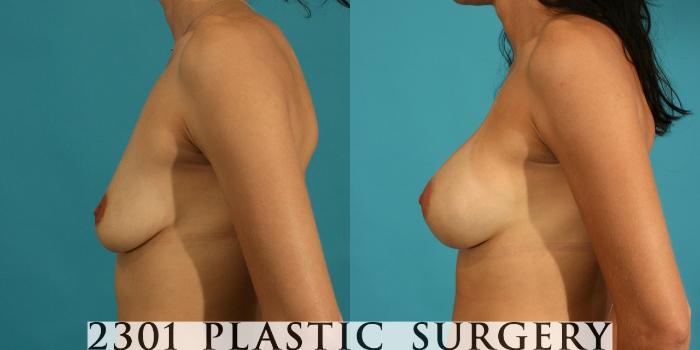 Before & After Breast Augmentation Case 9 View #2 View in Fort Worth, Plano, & Frisco, Texas