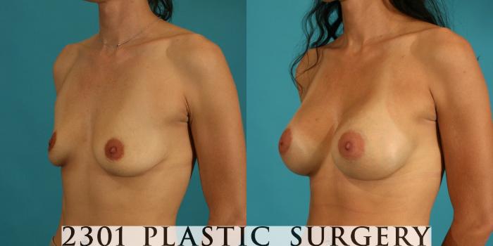Before & After Breast Augmentation Case 9 View #3 View in Fort Worth, Plano, & Frisco, Texas