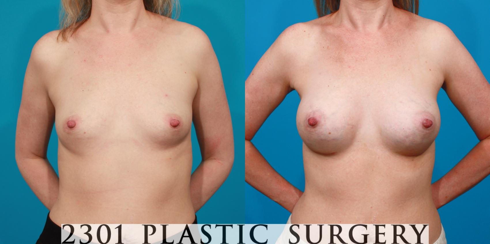 Before & After Breast Augmentation Case 91 View #1 View in Fort Worth, Plano, & Frisco, Texas