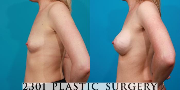 Before & After Silicone Implants Case 91 View #2 View in Fort Worth, Plano, & Frisco, Texas