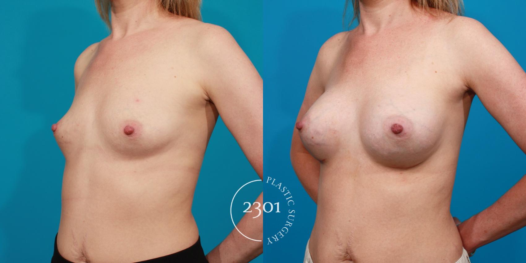 Before & After Silicone Implants Case 91 View #3 View in Fort Worth, Plano, & Frisco, Texas