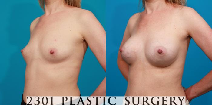 Before & After Silicone Implants Case 91 View #3 View in Fort Worth, Plano, & Frisco, Texas