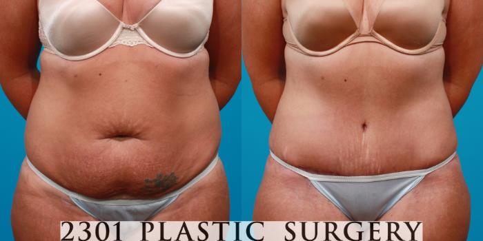 Before & After Tummy Tuck Case 108 View #1 View in Fort Worth, Plano, & Frisco, Texas
