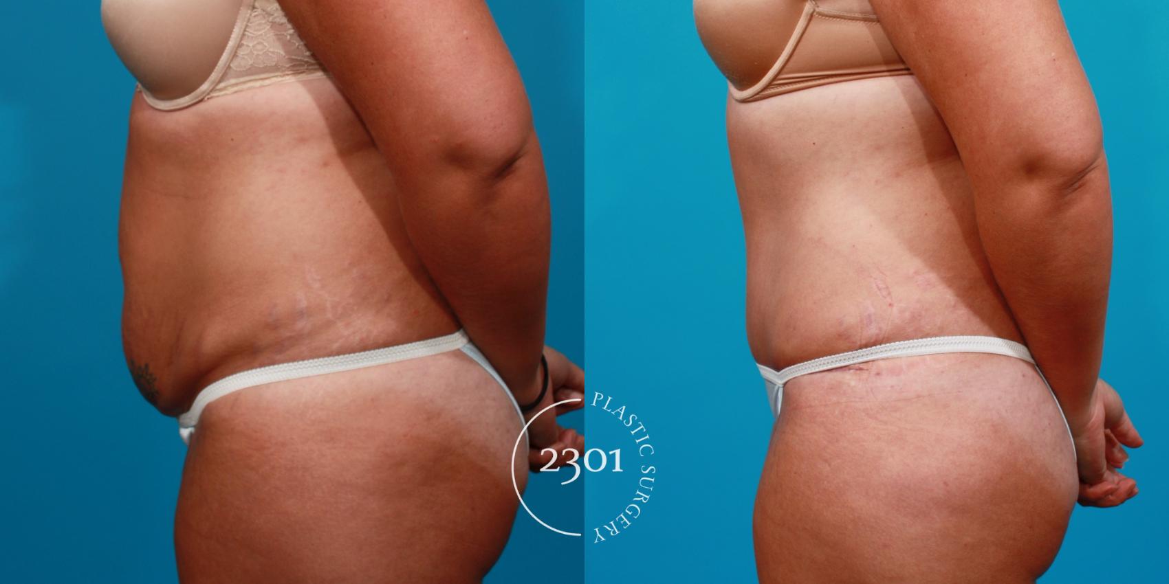 Before & After Tummy Tuck Case 108 View #2 View in Fort Worth, Plano, & Frisco, Texas