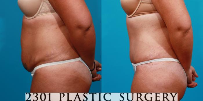 Before & After Tummy Tuck Case 108 View #2 View in Fort Worth, Plano, & Frisco, Texas