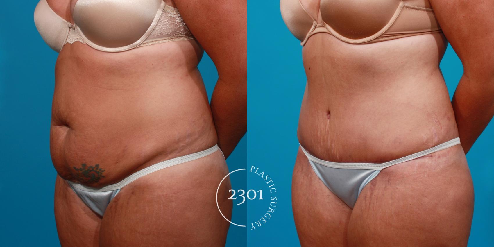 Before & After Tummy Tuck Case 108 View #3 View in Fort Worth, Plano, & Frisco, Texas