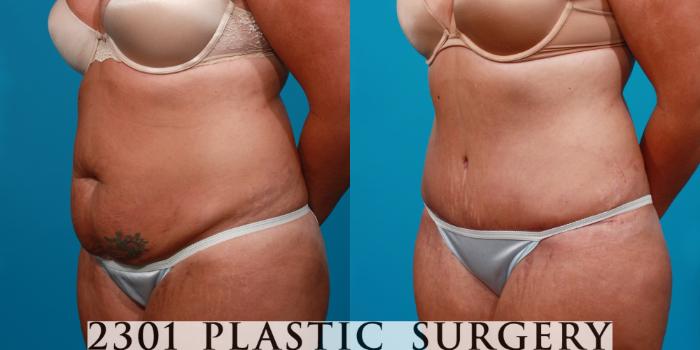 Before & After Tummy Tuck Case 108 View #3 View in Fort Worth, Plano, & Frisco, Texas