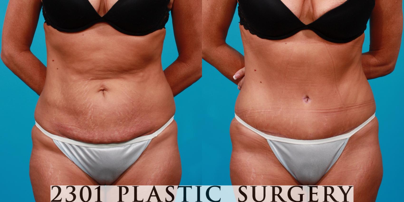 Unsure About Abdominoplasty? Learn the Top 10 Positives of Tummy Tuck  Surgery