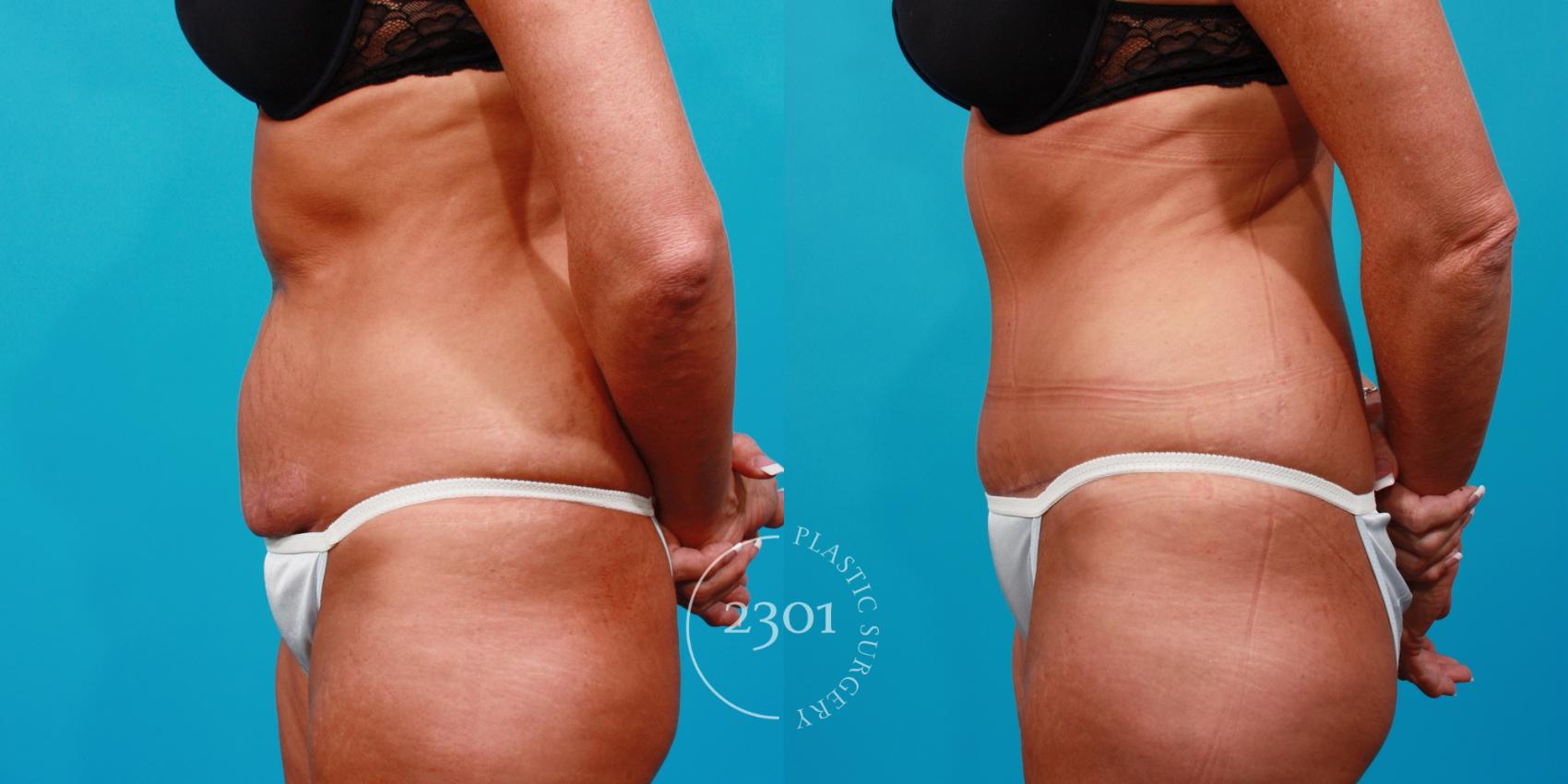 Before & After Tummy Tuck Case 110 View #2 View in Fort Worth, Plano, & Frisco, Texas