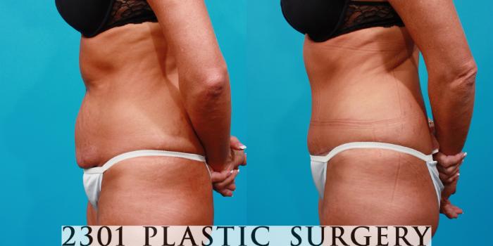 Before & After Tummy Tuck Case 110 View #2 View in Fort Worth, Plano, & Frisco, Texas
