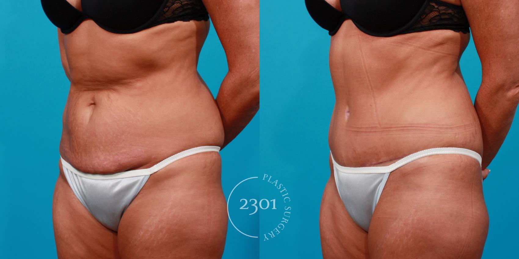 Before & After Tummy Tuck Case 110 View #3 View in Fort Worth, Plano, & Frisco, Texas