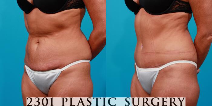 Before & After Tummy Tuck Case 110 View #3 View in Fort Worth, Plano, & Frisco, Texas