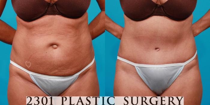 Before & After Tummy Tuck Case 122 View #1 View in Fort Worth, Plano, & Frisco, Texas
