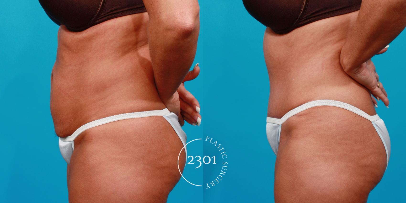 Before & After Tummy Tuck Case 122 View #2 View in Fort Worth, Plano, & Frisco, Texas
