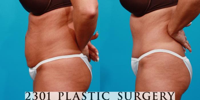Before & After Tummy Tuck Case 122 View #2 View in Fort Worth, Plano, & Frisco, Texas