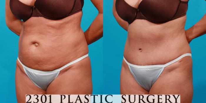 Before & After Tummy Tuck Case 122 View #3 View in Fort Worth, Plano, & Frisco, Texas