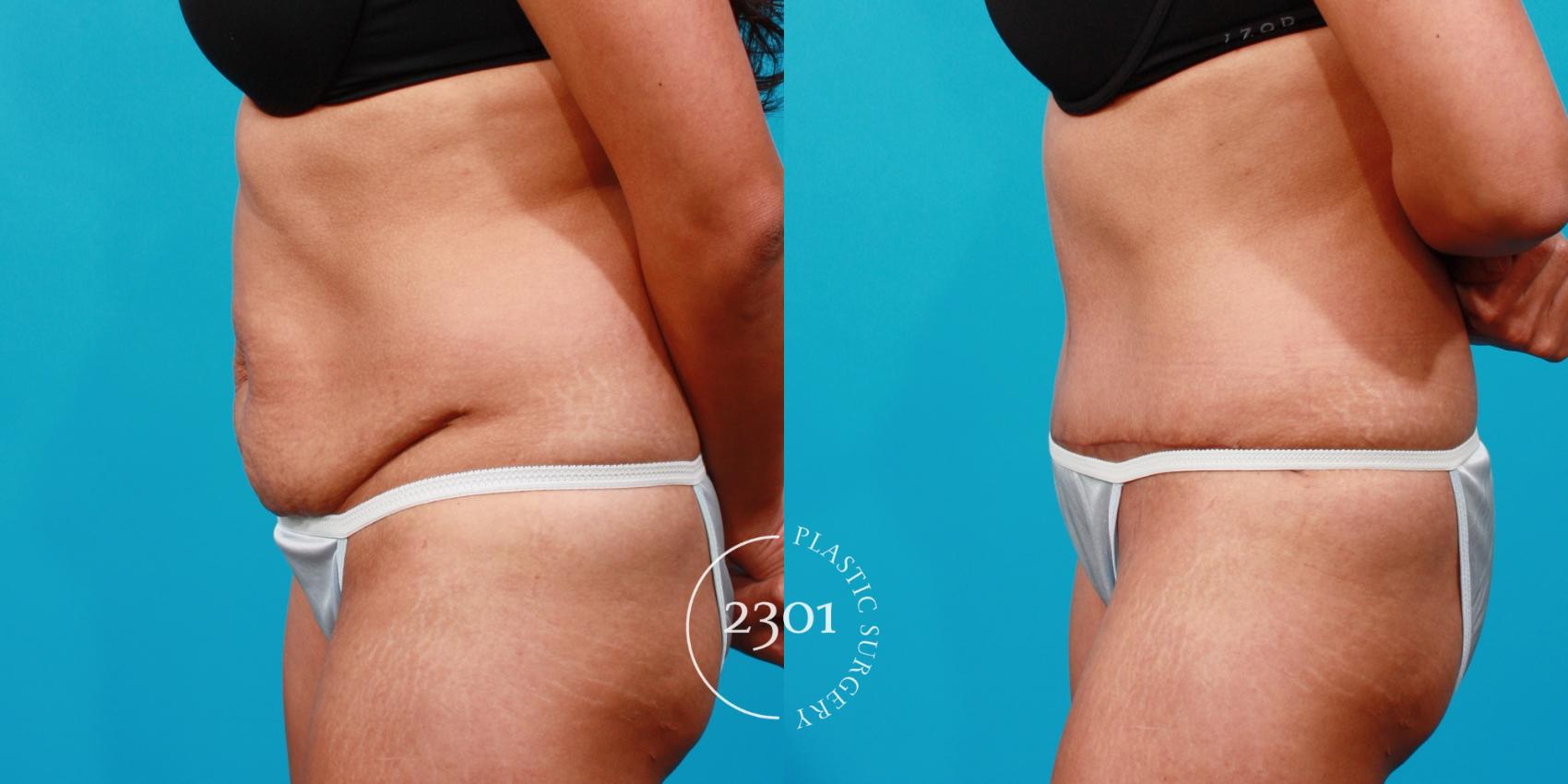 Before & After Tummy Tuck Case 126 View #2 View in Fort Worth, Plano, & Frisco, Texas