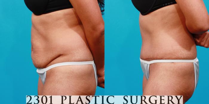 Before & After Tummy Tuck Case 126 View #2 View in Fort Worth, Plano, & Frisco, Texas
