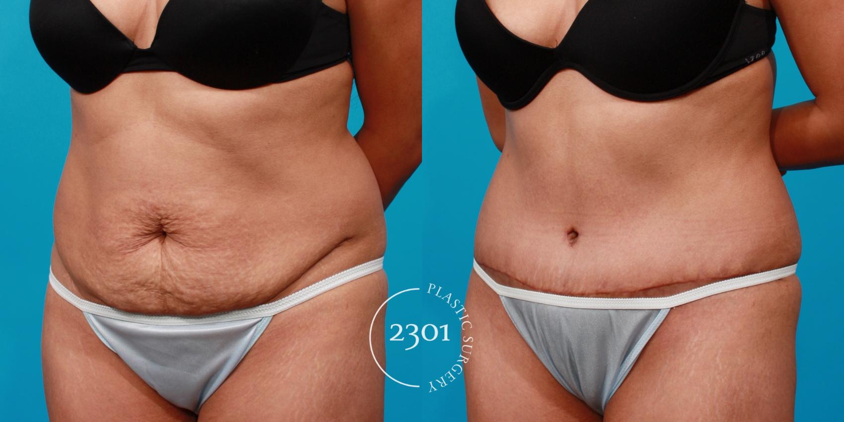 Before & After Tummy Tuck Case 126 View #3 View in Fort Worth, Plano, & Frisco, Texas