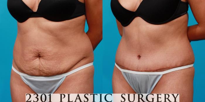 Before & After Tummy Tuck Case 126 View #3 View in Fort Worth, Plano, & Frisco, Texas