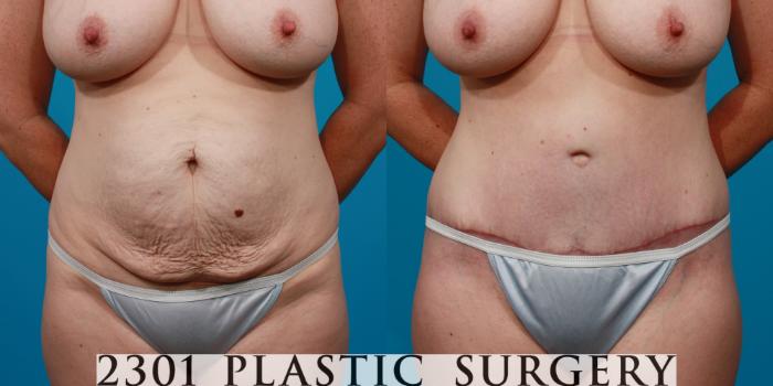 Before & After Tummy Tuck Case 131 View #1 View in Fort Worth, Plano, & Frisco, Texas