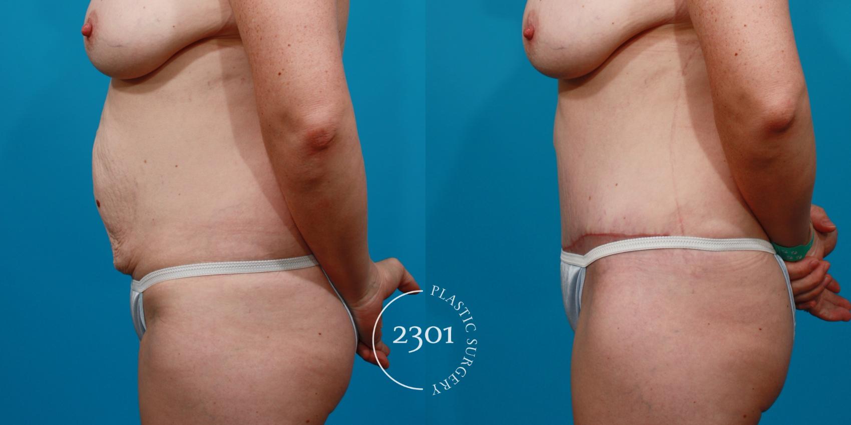 Before & After Tummy Tuck Case 131 View #2 View in Fort Worth, Plano, & Frisco, Texas