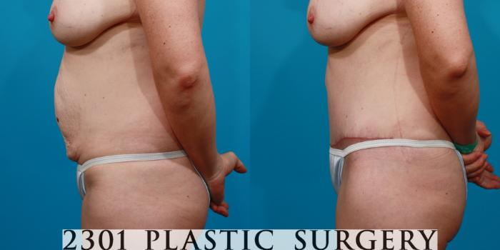 Before & After Tummy Tuck Case 131 View #2 View in Fort Worth, Plano, & Frisco, Texas