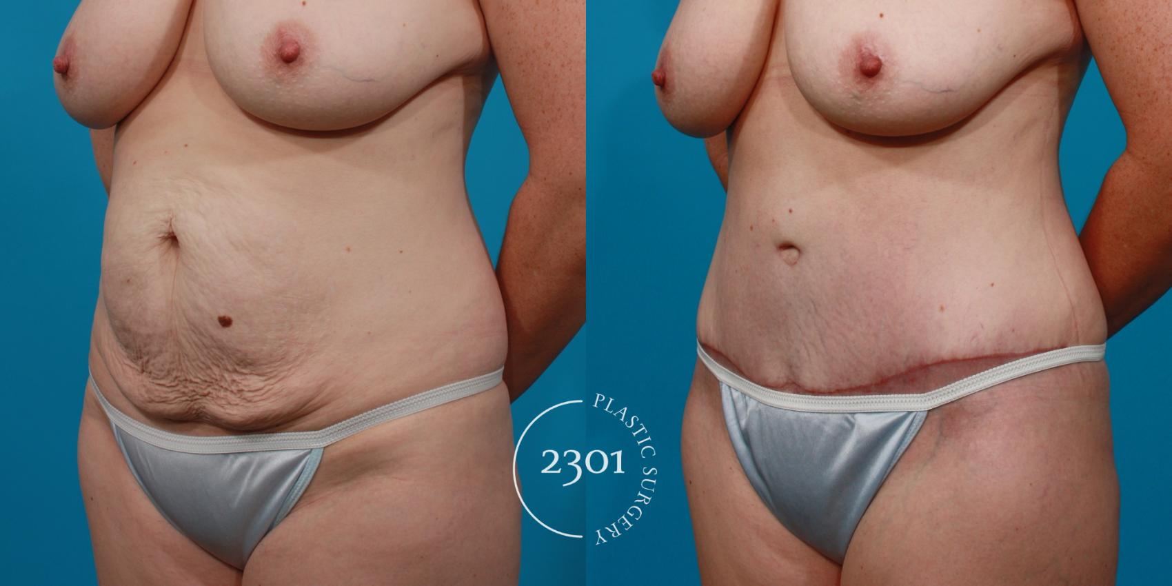Before & After Tummy Tuck Case 131 View #3 View in Fort Worth, Plano, & Frisco, Texas