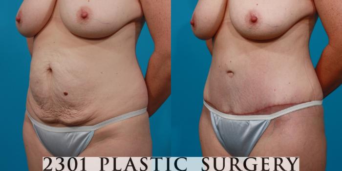 Before & After Tummy Tuck Case 131 View #3 View in Fort Worth, Plano, & Frisco, Texas