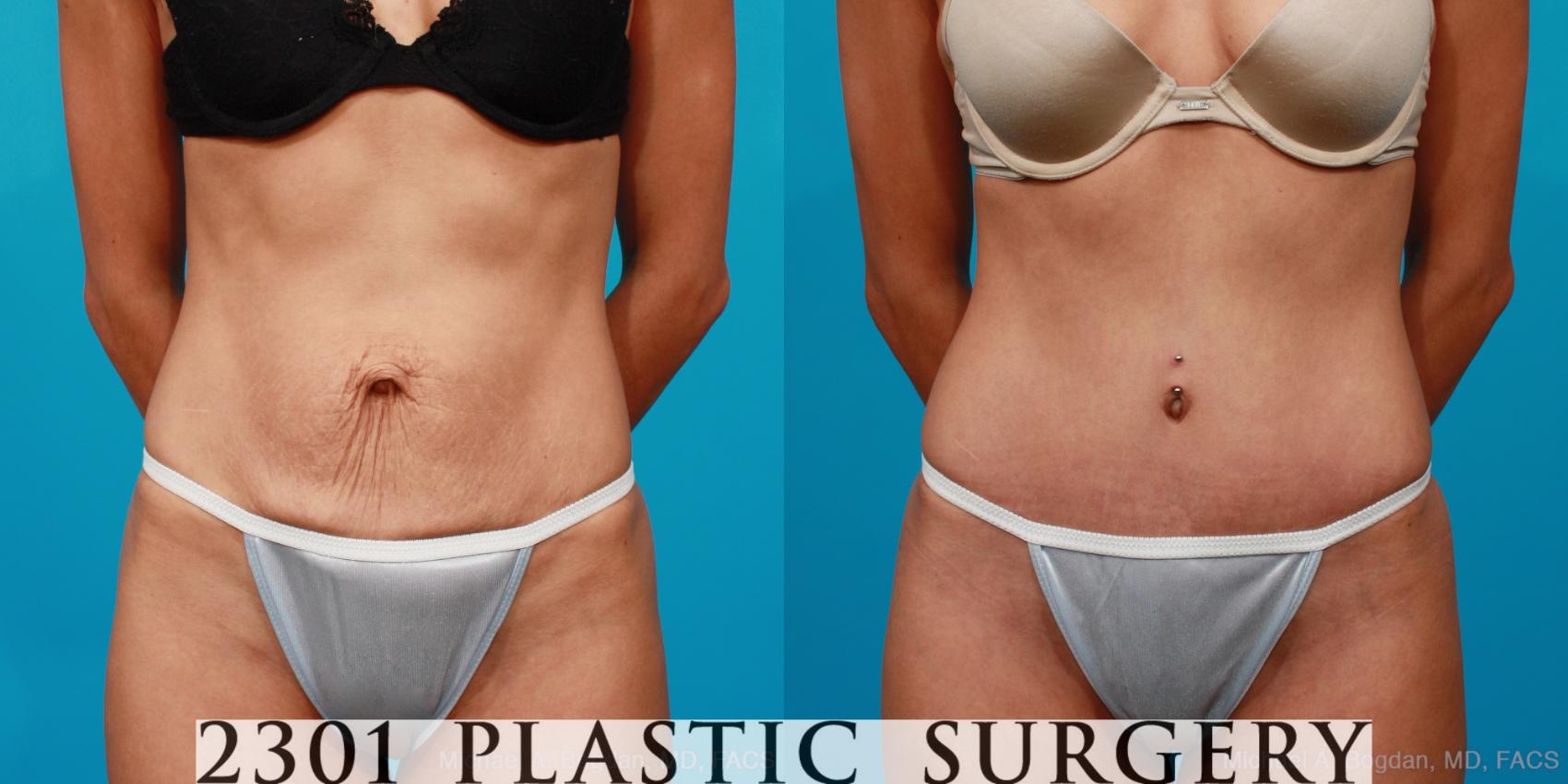 Before & After Tummy Tuck Case 134 View #4 View in Fort Worth, Plano, & Frisco, Texas
