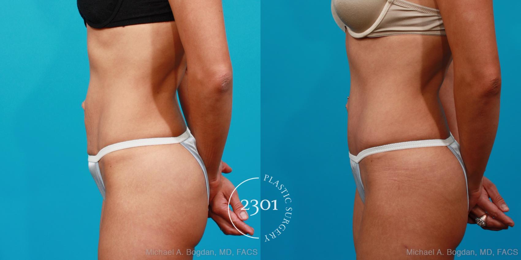 Before & After Tummy Tuck Case 134 View #5 View in Fort Worth, Plano, & Frisco, Texas