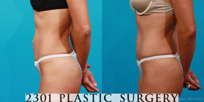 Before & After Tummy Tuck Case 134 View #5 View in Fort Worth, Plano, & Frisco, Texas