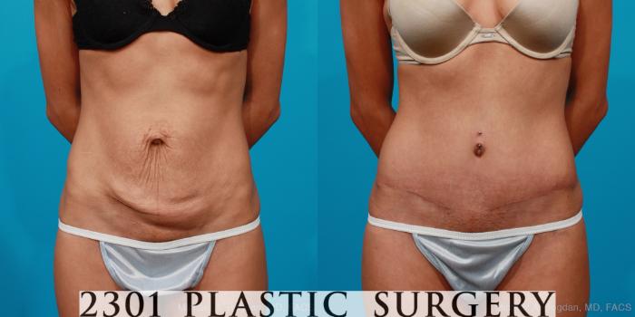Before & After Tummy Tuck Case 134 View #6 View in Fort Worth, Plano, & Frisco, Texas
