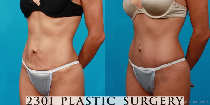 Before & After Tummy Tuck Case 134 View #7 View in Fort Worth, Plano, & Frisco, Texas