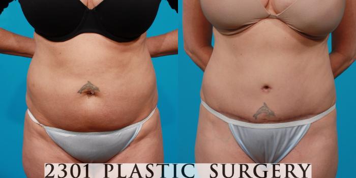 Before & After Tummy Tuck Case 146 View #1 View in Fort Worth, Plano, & Frisco, Texas