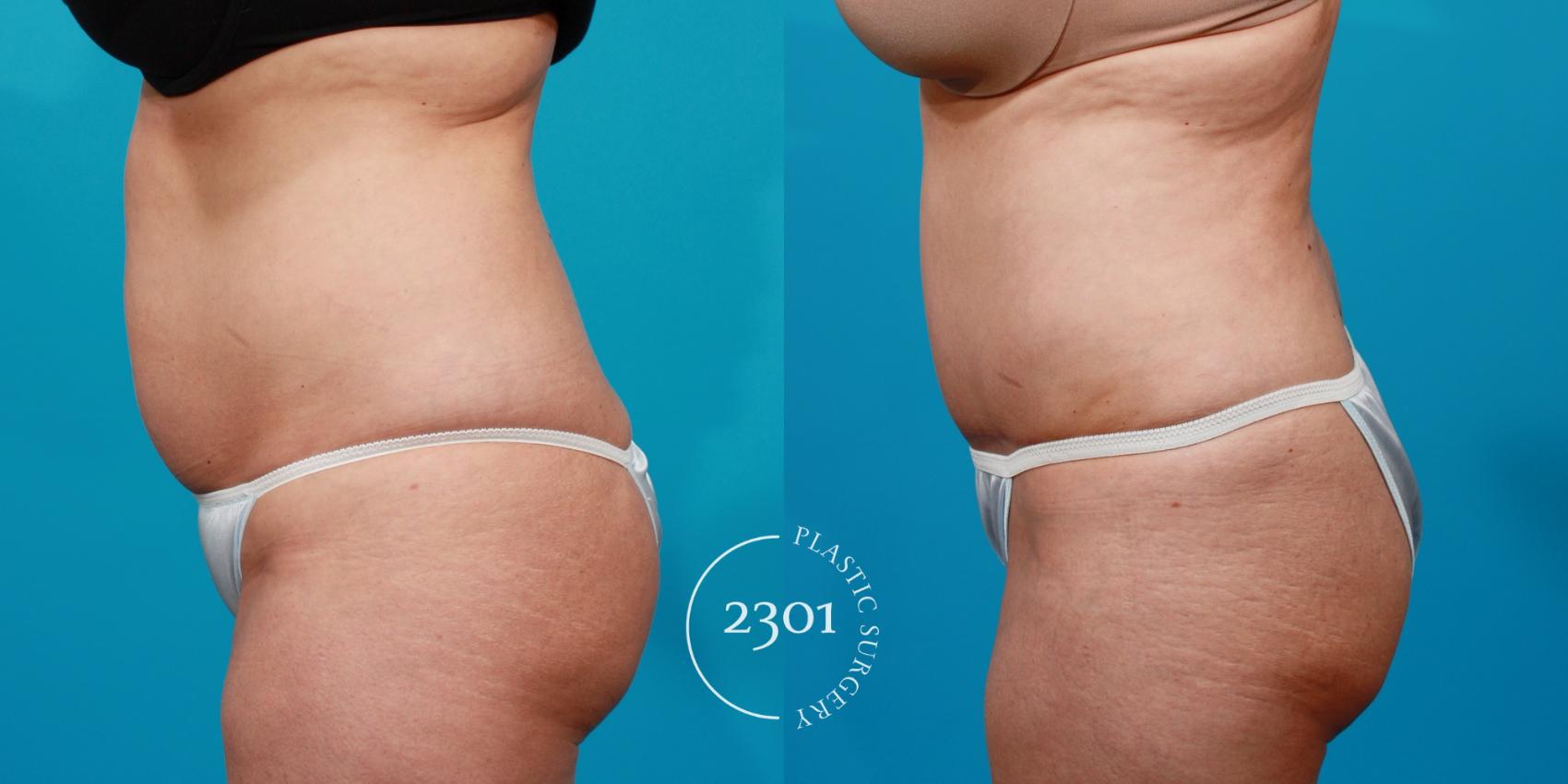 Before & After Tummy Tuck Case 146 View #2 View in Fort Worth, Plano, & Frisco, Texas