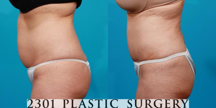 Before & After Liposuction Case 146 View #2 View in Fort Worth, Plano, & Frisco, Texas