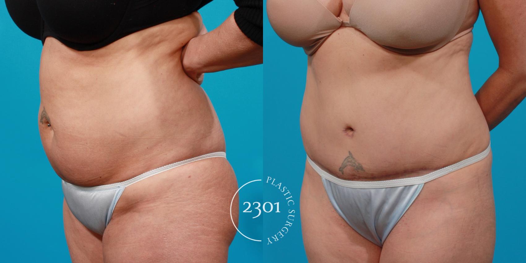Before & After Tummy Tuck Case 146 View #3 View in Fort Worth, Plano, & Frisco, Texas