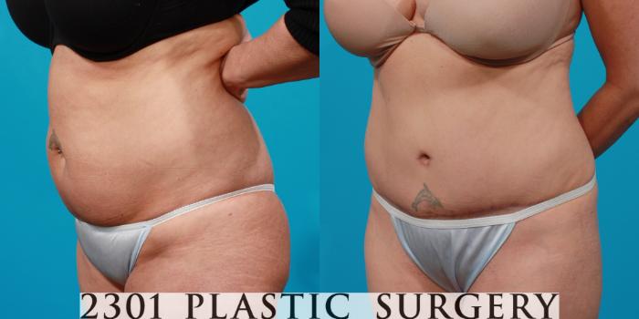 Before & After Tummy Tuck Case 146 View #3 View in Fort Worth, Plano, & Frisco, Texas