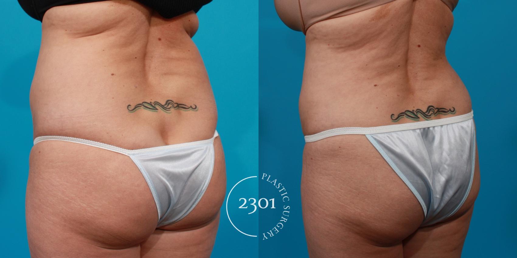 Before & After Tummy Tuck Case 146 View #4 View in Fort Worth, Plano, & Frisco, Texas