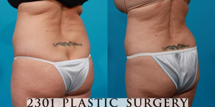 Before & After Liposuction Case 146 View #4 View in Fort Worth, Plano, & Frisco, Texas