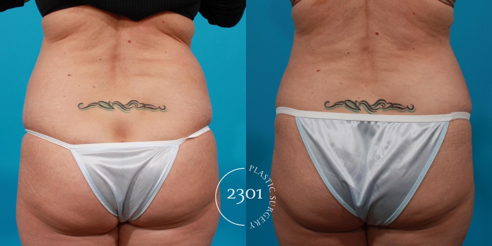 Before & After Tummy Tuck Case 146 View #5 View in Fort Worth, Plano, & Frisco, Texas
