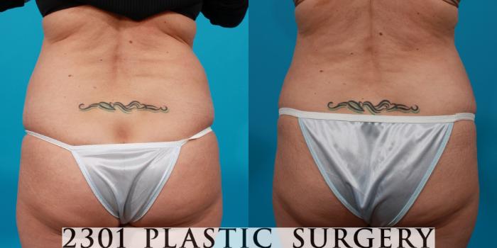Before & After Tummy Tuck Case 146 View #5 View in Fort Worth, Plano, & Frisco, Texas